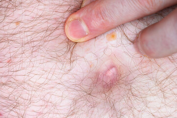 Fototapeta premium Finger pressing on hairy skin revealing a bump and yellowish scaly patches