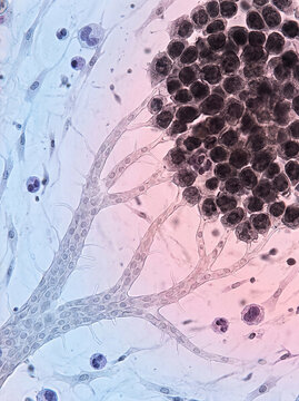 Tumor Invasion with Active Angiogenesis in Human Tissue
