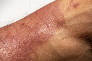 Fototapeta premium Extreme macro detail of inflamed red skin with severe allergic reaction or dermatitis