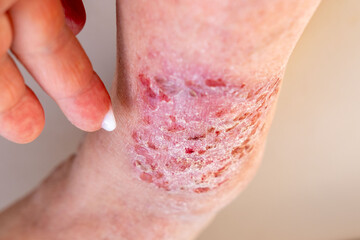 Fototapeta premium doctor treats large healing wound from lower leg with scars adult female patient, redness, diabetes disease, scarring skin, medical care, human tissue regeneration, hives and other skin manifestations
