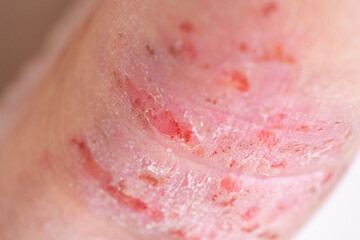 Fototapeta premium dermatitis allergic reactions, itchy skin on leg, closeup injured female limb damaged reddened skin scratches, wound on painful female leg, chronic dermatological disorder, skin problem, affected area
