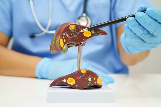 Cirrhosis, Liver cancer, fatty liver, Asian doctor with liver human anatomy model in World Hepatitis Day at hospital.