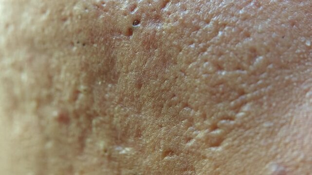 Extreme macro close-up of human facial skin texture showing enlarged pores (ostia), deep acne scars (atrophic scars), uneven texture, and minor blemishes on an adult cheek.