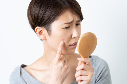 顔のにきびに悩む女性