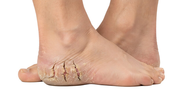 Close up of cracked heels on a persons feet showing dry skin and fissures.