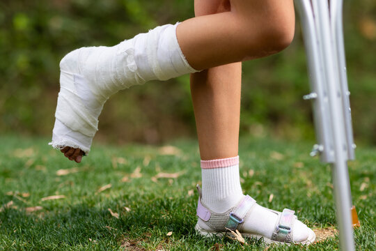 Little caucasian girl walking outdoor with plaster bandage on foot. Bone fracture foot and leg on child patient with splint cast and crutches during surgery rehabilitation and orthopedic recovery