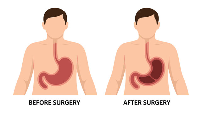 Comparative illustration showing a human stomach before and after a gastric bypass surgery for weight loss and medicine.