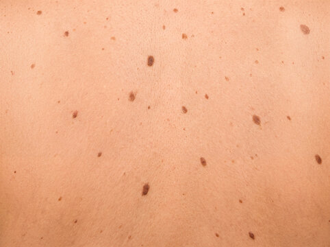 Skin mole freckle dermatology texture closeup human spot medical concept, natural skin texture with mole and freckle pattern