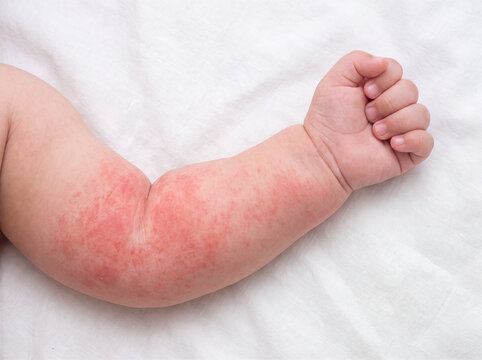 Baby arm rash eczema allergy skin infant arm with red rash and irritated skin white bedding, healthcare concept, concern mood
