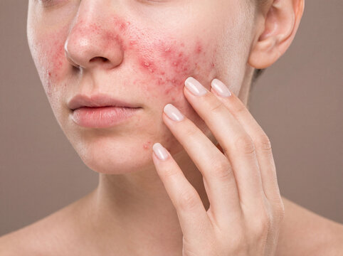 Acne skin face woman rash redness closeup Portrait of woman face with acne rash and redness cheek, touching skin with fingers