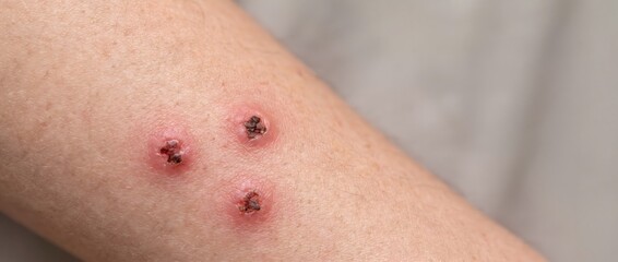 Fototapeta premium Close up view of infected red insect bites on human arm skin