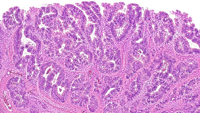 Small Intestine Adenocarcinoma Histopathology H&E Microscopy Tissue Section on White Background