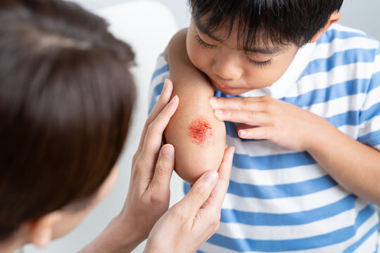 腕に擦り傷の怪我をする子供と手当てする母親・特殊メイク