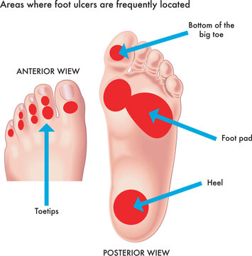 Medical illustration of areas where foot ulcers are frequently located.