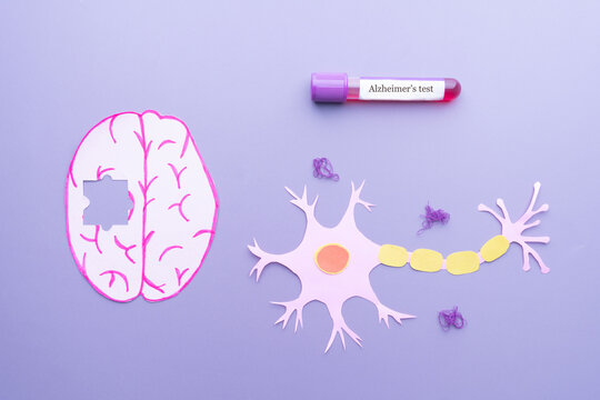 Brain missing a piece of jigsaw and nerve cells in neurodegenerative disease with amyloid plaques. Blood sample tube with Alzheimer test label that can help detect early signs of Alzheimer&rsquo;s disease.