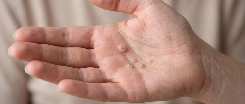 Verruca warts on human palm skin closeup showing viral skin infection symptoms