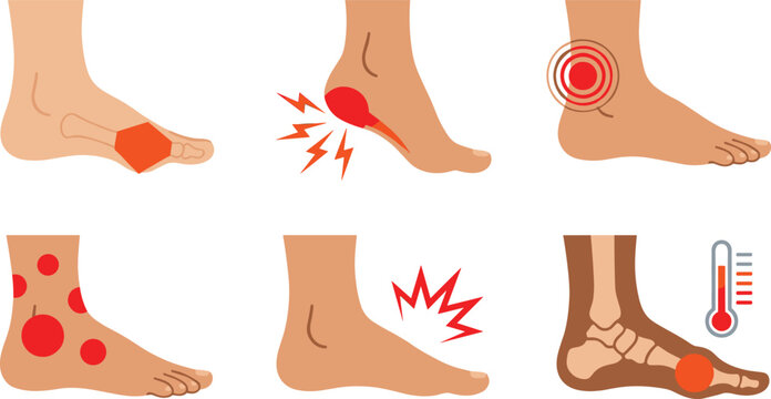 Foot and Ankle Pain Symptoms Vector Illustration Set Featuring Plantar Fasciitis Achilles Tendonitis Gout Rash and Joint Inflammation