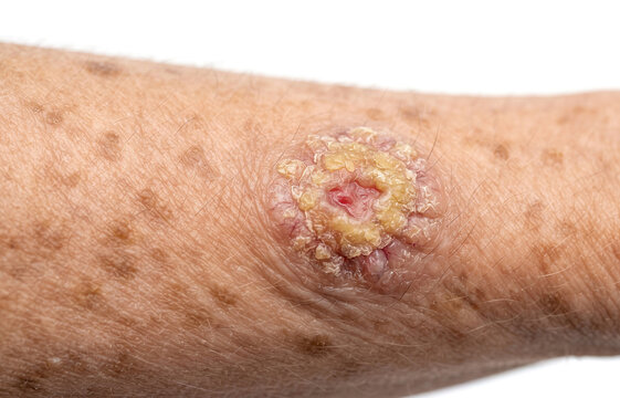 Keratoacanthoma or squamous cell carcinoma skin cancer lesion on human arm, malignant tumor or ulcerated dermatological condition