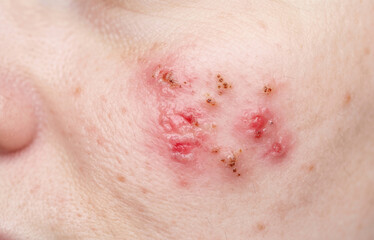 Fototapeta premium Herpes Simplex Infection on Female Cheek, Cluster of Vesicles and Scabs on Face Close Up