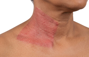Fototapeta premium Severe Erythema and Red Rash on Female Neck and Shoulder, Acute Skin Inflammation