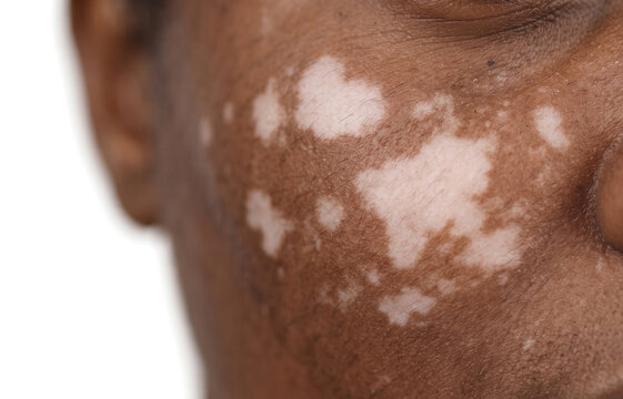 Vitiligo white patches depigmentation on dark skin female face close up