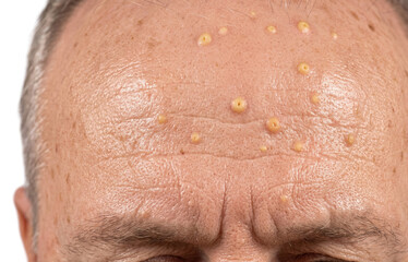 Naklejka premium Sebaceous Hyperplasia and Pustules on Senior Male Forehead, Close Up of Dermatological Skin Condition