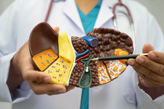 Cirrhosis, Liver cancer, fatty liver, Asian doctor with liver human model.