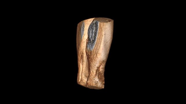 Coronal T2 MRI Scan Rotation of Bilateral Lower Legs for Vascular and Deep Soft Tissue Survey