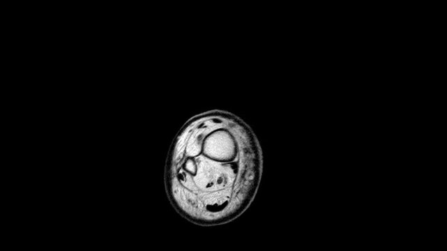 Coronal MRI View of Leg Musculature and Tibiofibular Bones for Surgical Planning