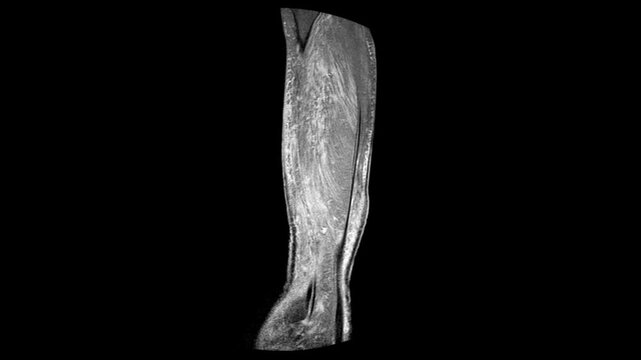 Magnetic Resonance Imaging Scan of Lower Leg Compartments for Deep Tissue Mass and Edema Screening