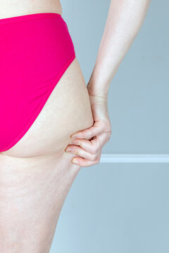 Woman pinching her thigh skin to show cellulite. Body positivity concept for aesthetic medicine. Young girl checking skin texture for skincare routine and beauty health improvement