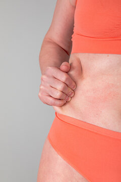 Woman holding side fat fold showing skin allergy with red spot on abdomen. Dermatology problem and body positivity concept. Healthcare checkup of skin condition and excessive weight