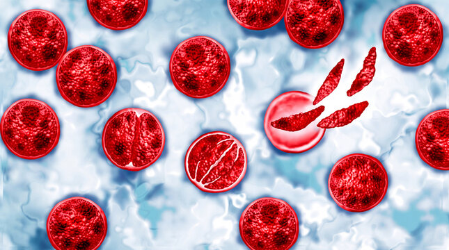 Microscopic view of sickle-shaped red blood cells, indicating sickle cell anemia, contrasted with normal round cells.