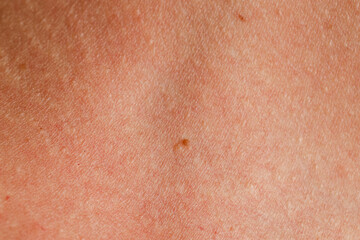 Fototapeta premium Texture of normal skin with birthmark as background, closeup
