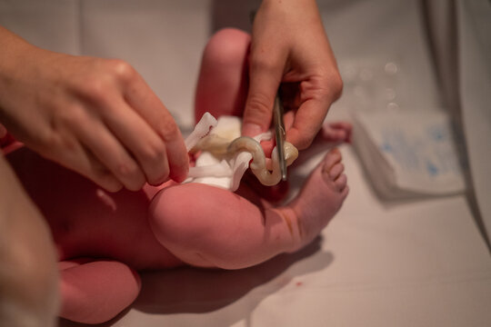 Coupe du cordon ombilical d'un nouveau-n&eacute; quelques instants apr&egrave;s la naissance en salle d'accouchement