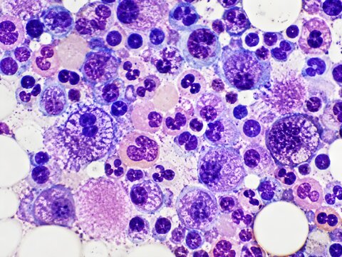 Bone Marrow Myelodysplastic Changes Showing Abnormal Cell Shapes Irregular Nuclei Disordered Maturation Scientific Illustration Detail