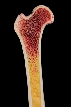 Bone marrow replacement by fatty tissue shown as gradual transition across long bone interior educationally