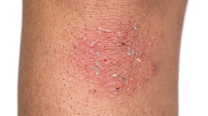 Fototapeta premium Close Up of Dry Peeling Skin with Redness and Flaking on Human Leg