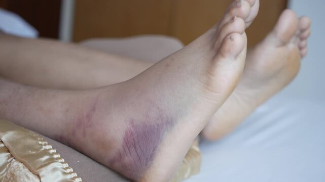 Swollen bruised ankle causing discomfort and pain in legs