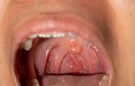 Close up of sore throat with swollen uvula, inflamed posterior pharyngeal wall and visible lymphoid follicles inside the oral cavity. Upper respiratory tract infection and healthcare concepts.