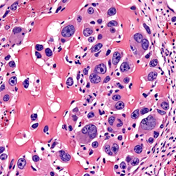 Histopathology of High-Grade Malignant Neoplasm with Pleomorphic Cells and Osteoid Matrix