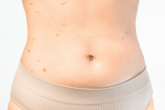 Female belly with many moles and slight bloating. Body care and health concept. Front view close up of a woman stomach in underwear showing birthmarks, skin nevi, overeating bloating or weight gain.