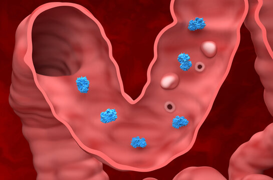 Inflammation or perforation in colon by NSAID overdose - isometric view 3d illustration