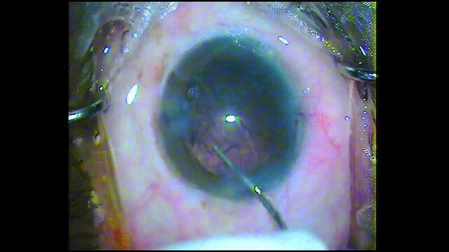 Surgeon Performing Cataract Phacoemulsification On Human Eye