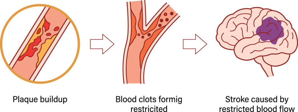 Medical vector diagram of ischemic stroke, showing plaque buildup, blood clots, and brain damage