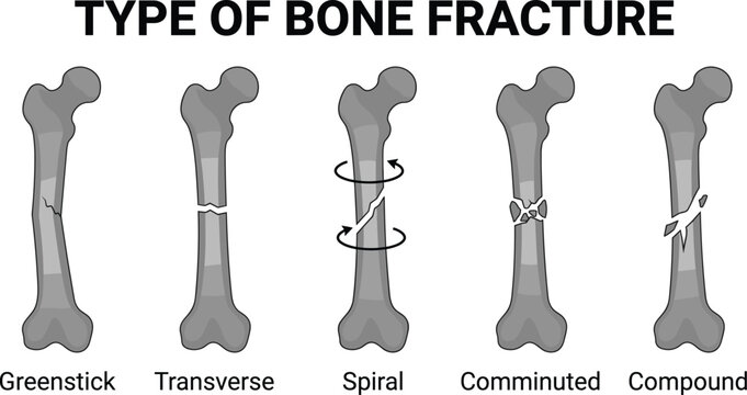 Vector diagram of human bone fracture types including greenstick, transverse, spiral, comminuted, and compound