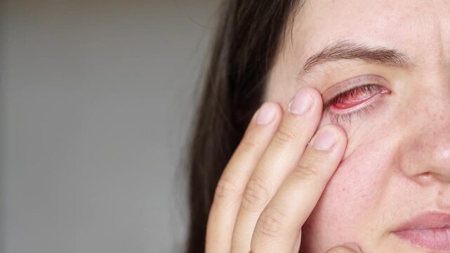 Slow motion video of young woman touching inflamed eye in close up. Red eyeball shows pain and discomfort. Eye irritation needs proper treatment.