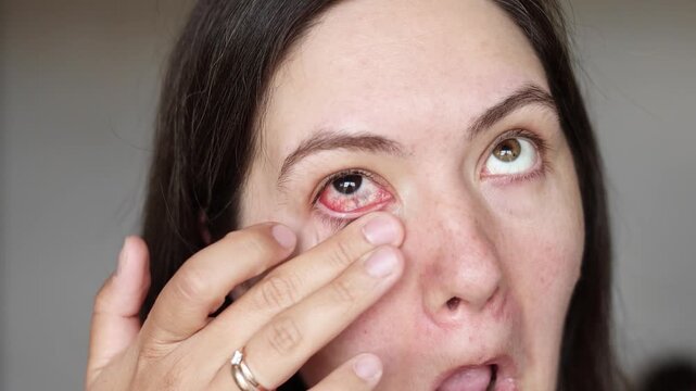 Slow motion close up shows young woman rubbing inflamed red eye with finger. Eye infection causes visible redness and irritation. Medical care helps recovery.