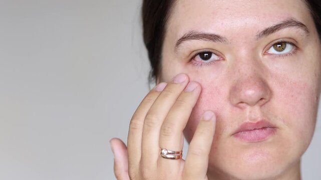 Slow motion video of young woman touching inflamed eye in close up. Red eyeball shows pain and discomfort. Eye irritation needs proper treatment.