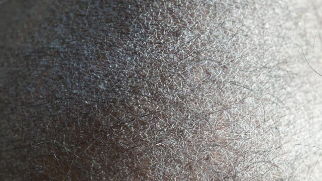 Close up view of the dry and flaky skin with stubble hair of the head of a man due to skin disease or aging